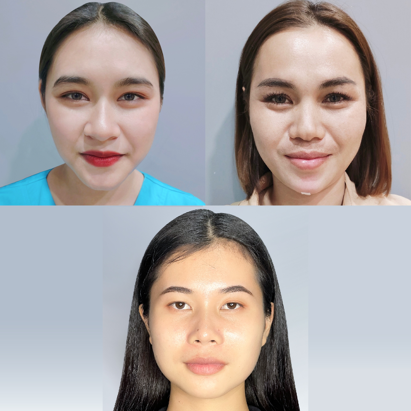 รวมรีวิว HIFU ยกกระชับ